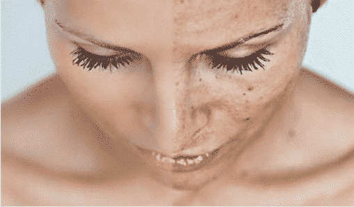vrouw met pigmentvlekken in haar gezicht