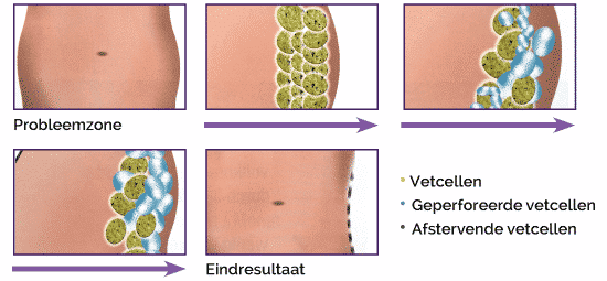 coolsculpting werking