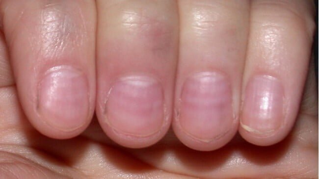 geribbelde nagels en ribbels in nagels